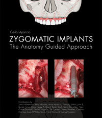 Zygomatic Implants: The Anatomy Guided Approach
