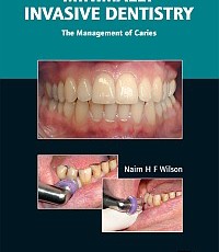 Minimally Invasive Dentistry: The Management of Caries