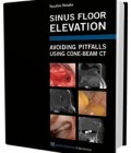 Sinus Floor Elevation