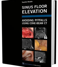 Sinus Floor Elevation