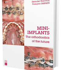 Mini-Implants: The orthodontics of the future