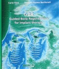 GBR Guided Bone Regeneration for implant therapy