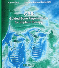 GBR Guided Bone Regeneration for implant therapy