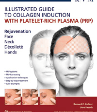 Illustrated Guide to Collagen Induction with Platelet-Rich Plasma (PRP)