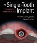 The Single-Tooth Implant