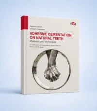 Adhesive cementation on natural teeth
