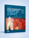 Bone regeneration in implantology: tooth as a graft
