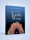 Managing Tooth Wear