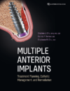 Multiple Anterior Implants