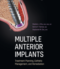 Multiple Anterior Implants